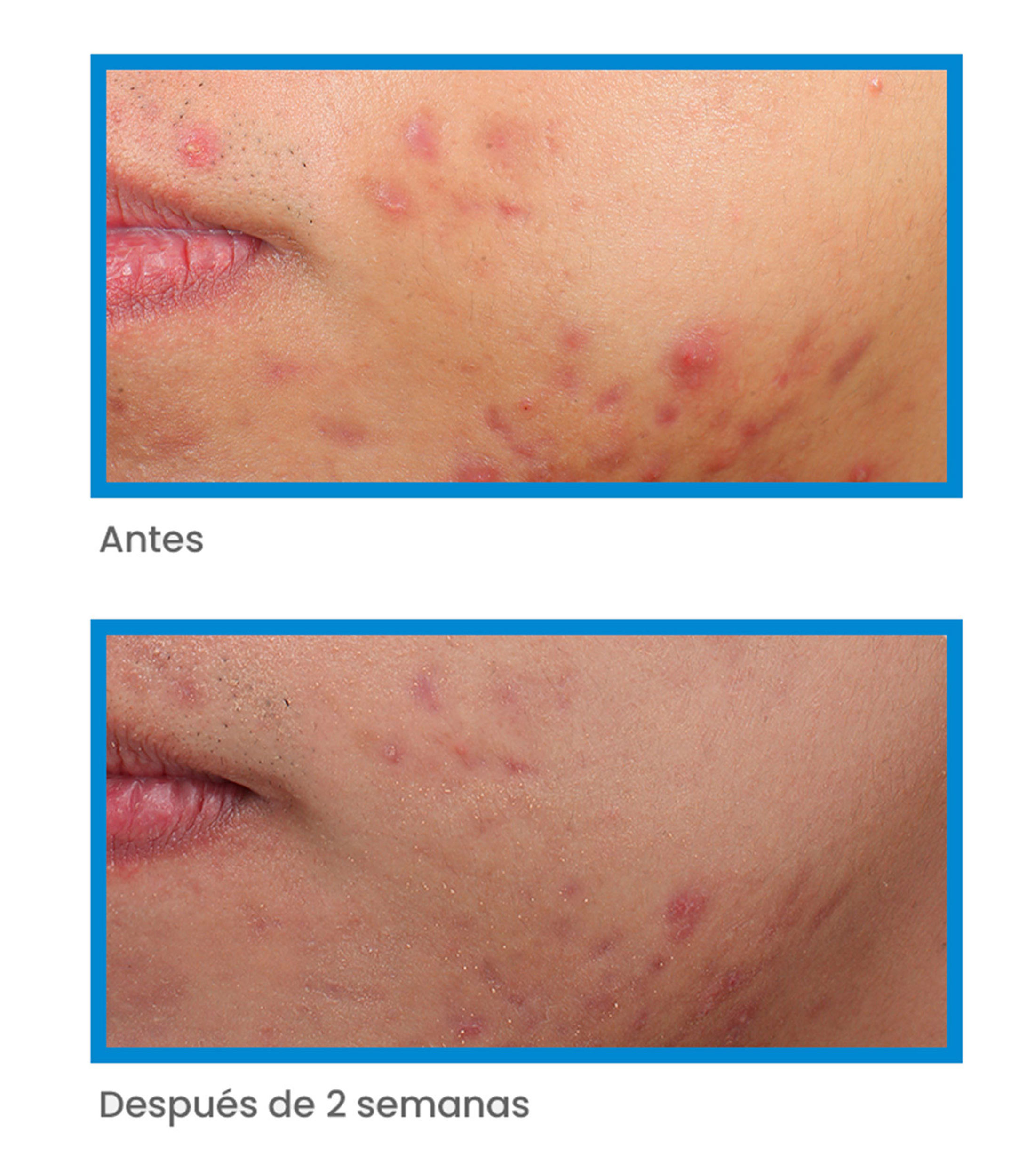 Tratamiento Anti imperfecciones Deep Relief Blemish, 30 ml