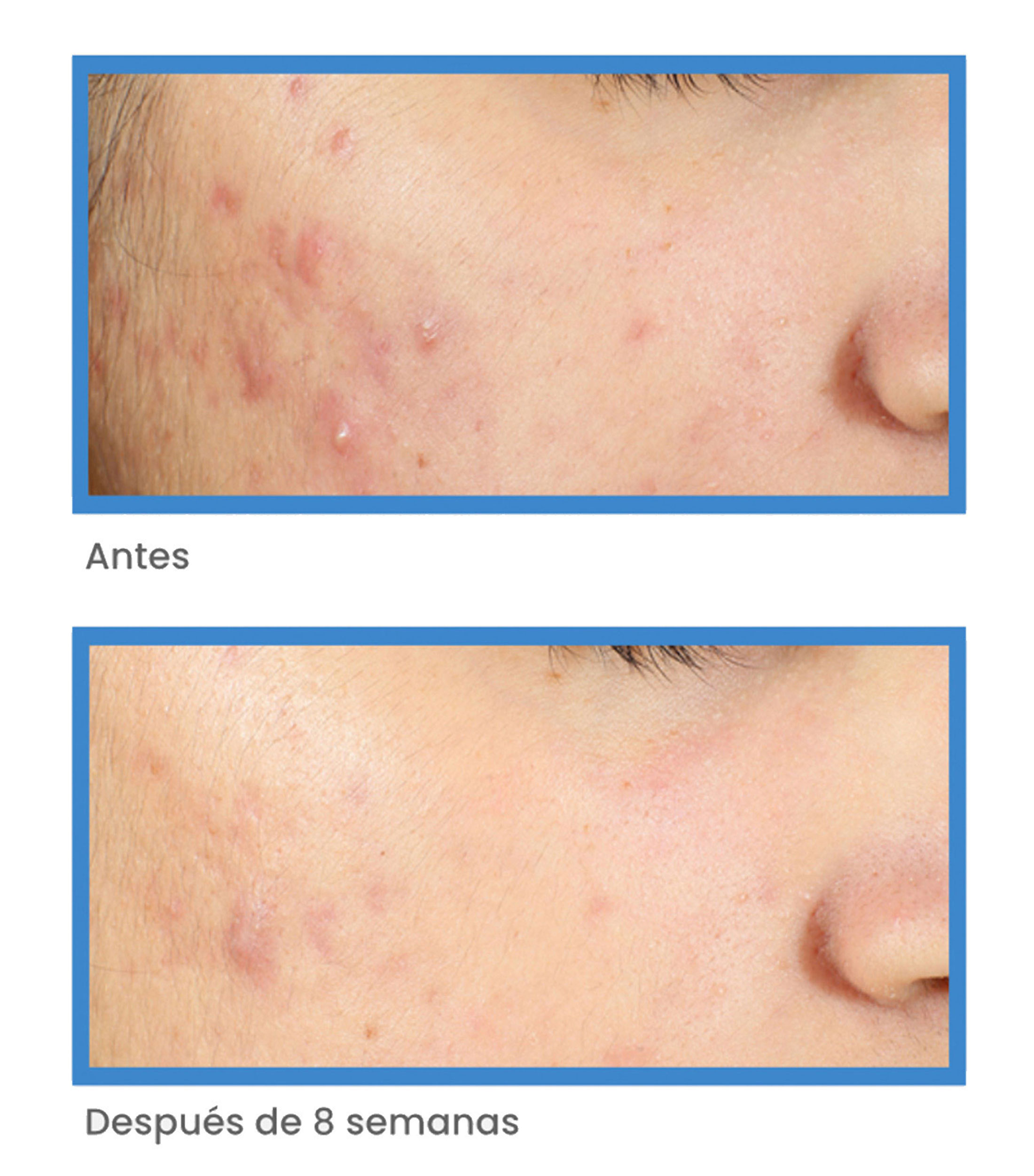 Tratamiento Anti imperfecciones InvisiScar Resurfacing, 15 ml