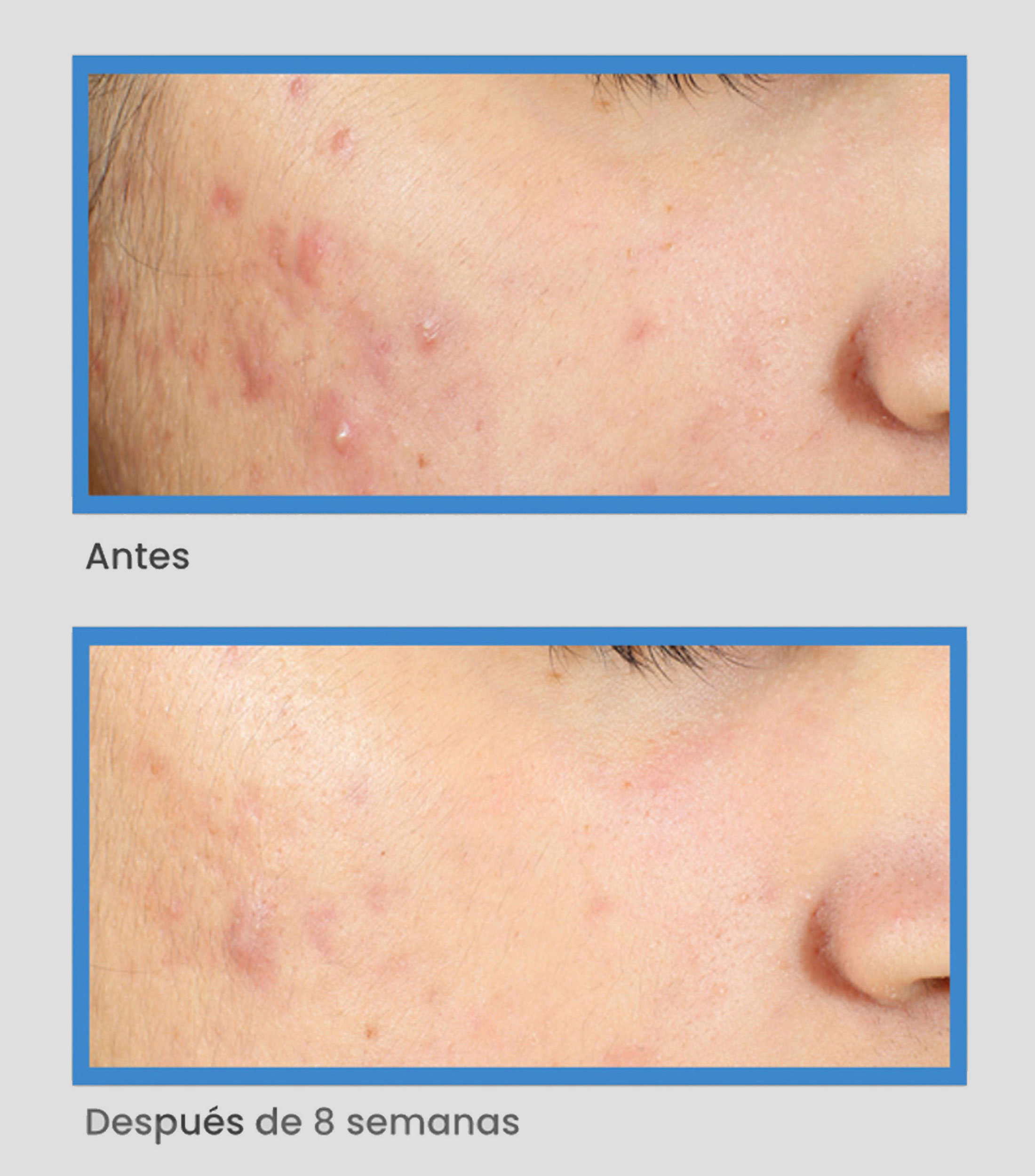 Tratamiento Anti imperfecciones InvisiScar Resurfacing, 15 ml